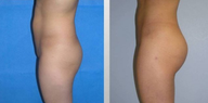 Butt Augmentation (Fat Transfer)
