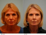 Fat Transfer