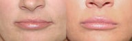 Fat Transfer