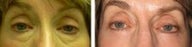 Transconjunctival arcus release and fat grafting