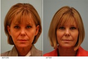 Facial Fat Transfer
