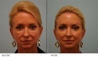 Corrective Fat Transfer