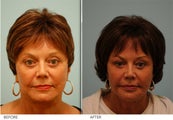 Corrective fat transfer