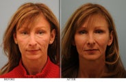 Full Face Fat Transfer