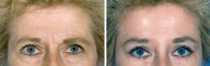 Forehead Lift