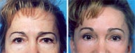 Forehead Lift