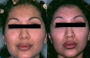 Brow and Forehead Lift