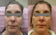 Fractional Laser