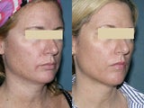 Fraxel Laser