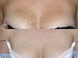 Fraxel Laser