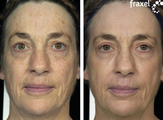 Fraxel for pigmentation and skin laxity