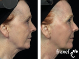 Fraxel for skin tightening