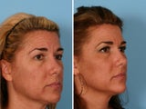 Fraxel Laser