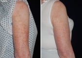 Fraxel laser resurfacing 