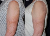 Fraxel laser resurfacing 