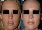 Fraxel Laser Resurfacing