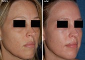 Fraxel Laser Resurfacing