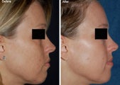 Fraxel Laser Resurfacing