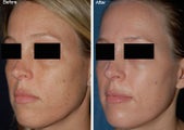 Fraxel Laser Resurfacing