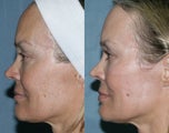 Fraxel Repair for sun damage and wrinkles
