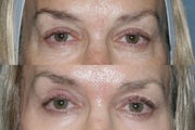 Fraxel Repair for sun damage and wrinkles