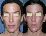 Fraxel repair for sun damage, melasma on face and neck