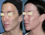 Fraxel repair for sun damage, melasma on face and neck