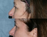 Fraxel Repair