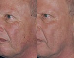 Laser Resurfacing