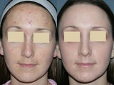 Fraxel Repair for melasma, acne and scars
