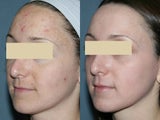 Fraxel Repair for melasma, acne and scars