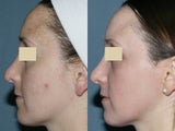 Fraxel Repair for melasma, acne and scars