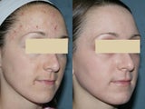 Fraxel Repair for melasma, acne and scars