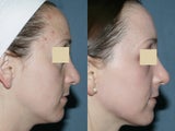 Fraxel Repair for melasma, acne and scars