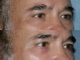 Fraxel Repair for under eye wrinkles and laxity