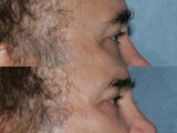 Fraxel Repair for under eye wrinkles and laxity
