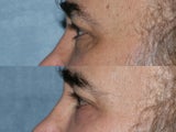 Fraxel Repair for under eye wrinkles and laxity