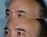 Q-switched alexandrite treatment of age spots