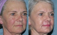 Fraxel Repair in Combination with other lasers