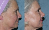 Fraxel Repair in Combination with other lasers