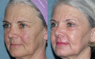 Fraxel Repair in Combination with other lasers