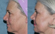 Fraxel Repair in Combination with other lasers