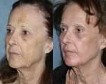 Fraxel Repair in Combination with other lasers yields best results