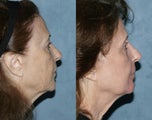 Fraxel Repair in Combination with other lasers yields best results