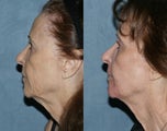Fraxel Repair in Combination with other lasers yields best results
