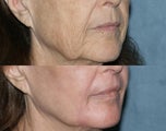 Fraxel Repair in Combination with other lasers yields best results