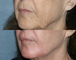 Fraxel Repair in Combination with other lasers yields best results