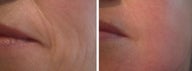 Green Peel to Wrinkles on cheek