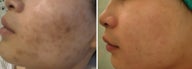 Green peel to hyper-pigmentation of cheek