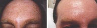 Greben peel to freckles on forehead